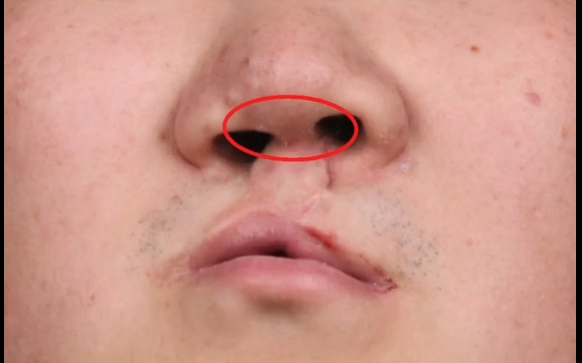 唇裂鼻修復(fù)：去骨VS不取骨，余文林醫(yī)生解析真相