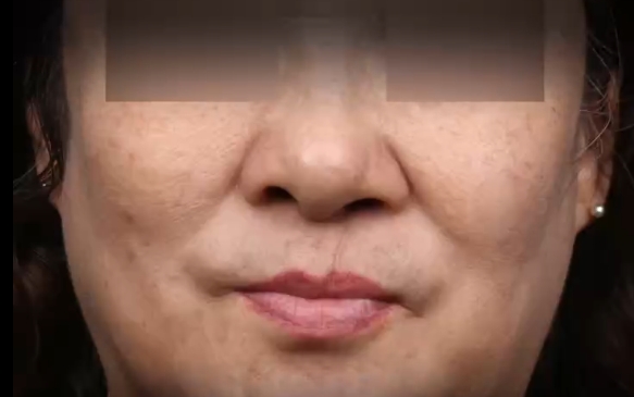 62歲第一次做唇裂修復(fù)，余文林醫(yī)生案例分享