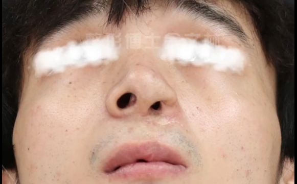 唇裂鼻修復(fù)：為何結(jié)果塌了？余文林醫(yī)生解析 