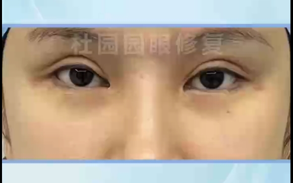 杜園園醫(yī)生親授雙眼皮新月型改善秘笈，讓你眼神閃亮 
