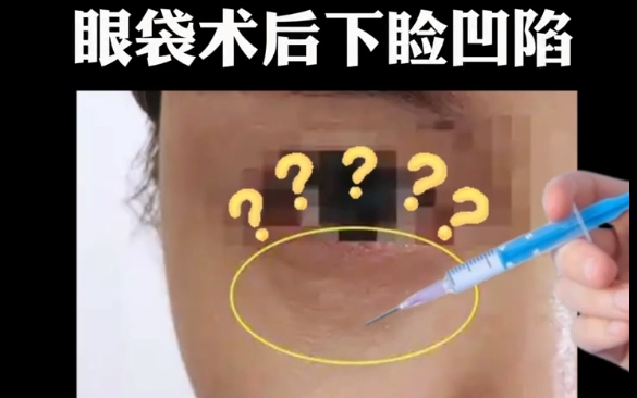 解密眼袋術(shù)后下瞼凹陷，注射是解決之道嗎？杜園園醫(yī)生揭秘 