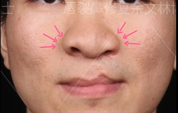 正鼻翼緣不對稱和患側(cè)唇峰上移問題？余文林醫(yī)生案例分享