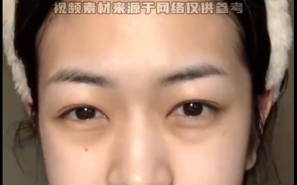 魏皎醫(yī)生揭秘：普通人的淚溝改善策略，讓你眼神煥發(fā)青春