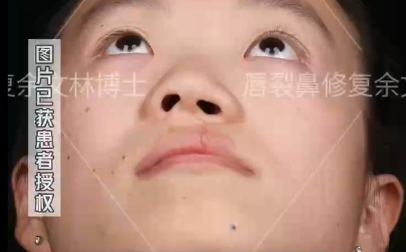 小時(shí)候的唇裂沒修復(fù)好會(huì)變成怎樣？余文林醫(yī)生解析