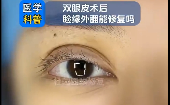 杜園園醫(yī)生分享：雙眼皮術(shù)后瞼緣外翻有解決辦法嗎？