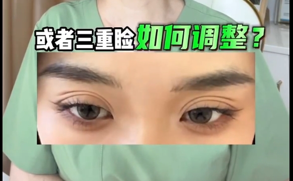 雙眼皮術(shù)后多重瞼困擾？杜園園醫(yī)生揭秘調(diào)整技巧