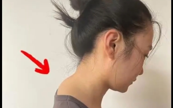 富貴包大揭秘！程辰醫(yī)生為您解讀