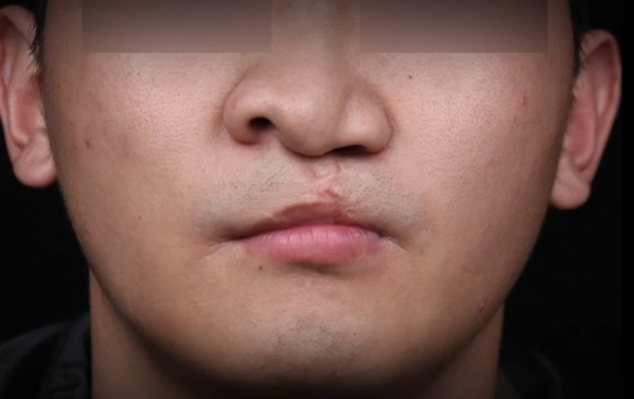 嚴(yán)重唇裂鼻，口鼻漏1.5cm怎么辦？余文林醫(yī)生帶您揭秘