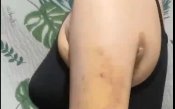 吸脂后四個階段，哪個更難受？