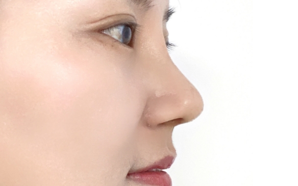 隆鼻假體取出攣縮了？是不是這一步?jīng)]有做？