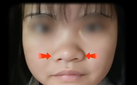 魏皎醫(yī)生解密：如何讓鼻子自然縮小，告別不滿意的鼻翼 