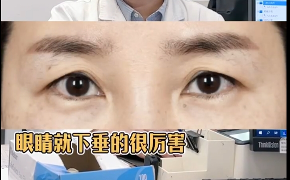 40歲眼皮下嚴(yán)重下垂，雙眼皮or提眉？