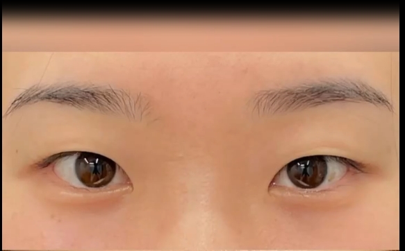 十個(gè)眼角九個(gè)疤是真的嗎？馮少清醫(yī)生在線解答