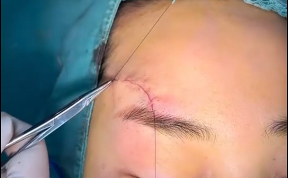 疤痕愈合后好不好看，關(guān)鍵看這4點(diǎn)，馮少清醫(yī)生解答