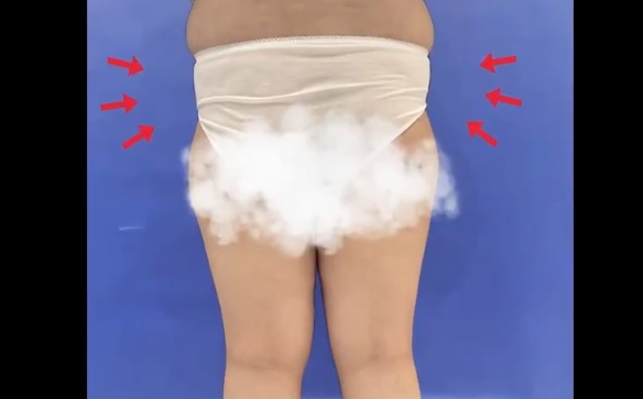 大腿環(huán)吸+臀部填充，一次解決多個問題，程辰醫(yī)生案例分享