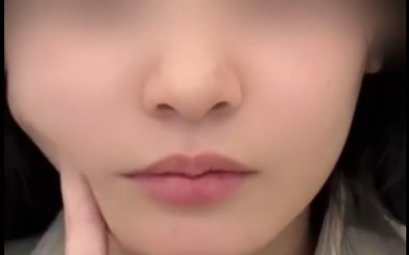 程辰醫(yī)生揭秘下頜緣術(shù)：如何避免垮臉尷尬？