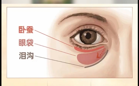 40歲男性眼袋嚴(yán)重，外切手術(shù)解決3重問題