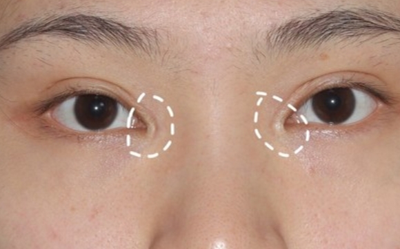包完內(nèi)眼角后為何會出現(xiàn)空心洞？杜園園醫(yī)生解答