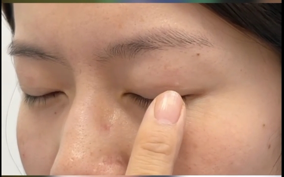 腫眼泡雙眼皮做對(duì)這點(diǎn)不踩坑！