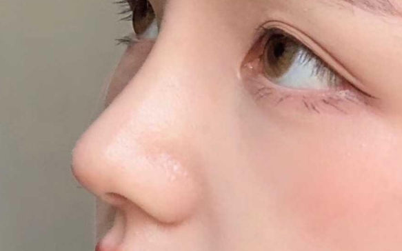 感染？穿出？不好??？膨體隆鼻究竟能不能用