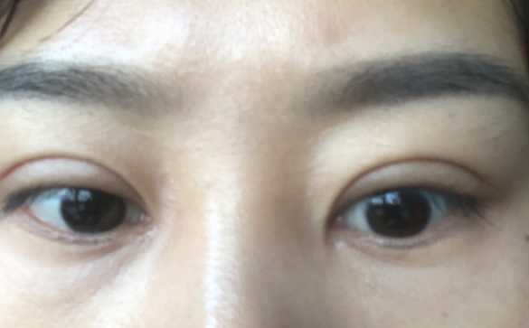 雙眼皮深如何修復(fù)，降窄能解決問題嗎？杜園園醫(yī)生回答你
