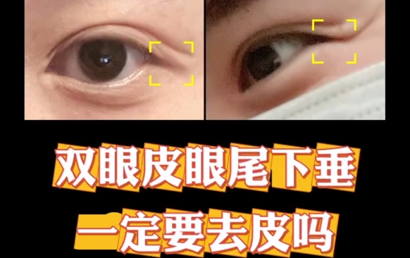 雙眼皮眼尾下垂一定要去皮嗎？杜園園醫(yī)生告訴你答案