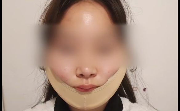 面部吸脂半年沒恢復(fù)？是這三點沒注意！程辰醫(yī)生在線解答