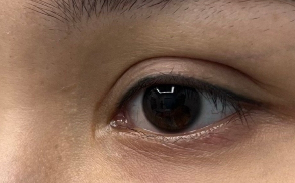 內(nèi)眼角括號(hào)疤，什么原因？怎么處理？