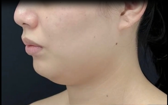 普通女孩兒的面部吸脂指南，程辰醫(yī)生帶你揭秘！ 
