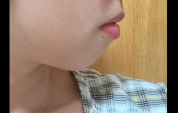 下巴后縮戴牙套還是做醫(yī)美？魏皎醫(yī)生揭秘