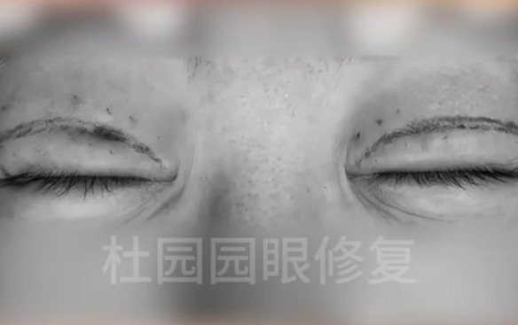 雙眼皮凹陷疤痕，里面發(fā)生了什么？杜園園醫(yī)生在線解答