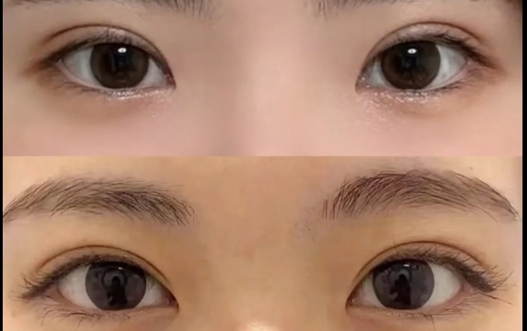 哪種雙眼皮更適合亞洲人？