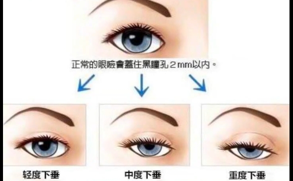 上瞼下垂是全麻嗎？怎么配合？周顯玉醫(yī)生解答