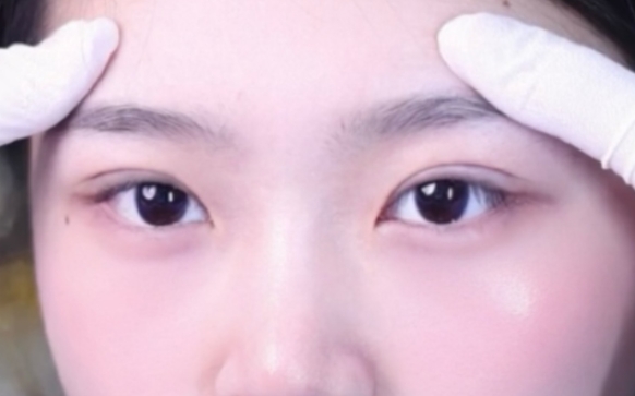 雙眼皮手術(shù)：如何打造開(kāi)扇雙眼皮？周顯玉醫(yī)生案例分享
