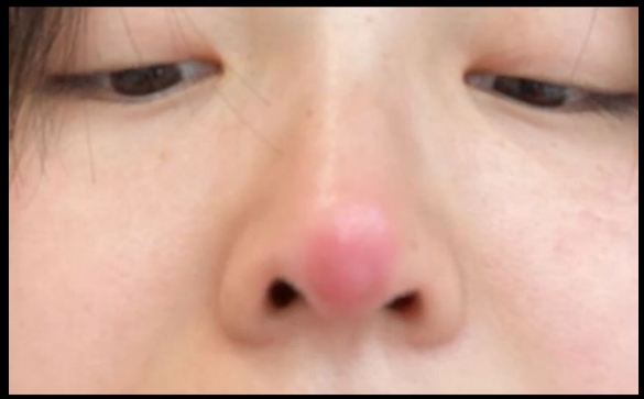 隆鼻之后攣縮，這樣修復(fù)效果好！魏皎醫(yī)生解答