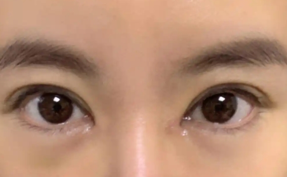 包眼角失敗還能再修復(fù)嗎？杜園園醫(yī)生解答
