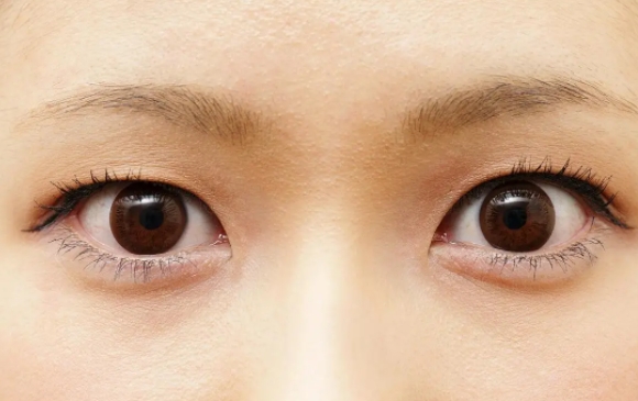 上瞼下垂是否能一次到位？周顯玉醫(yī)生解答