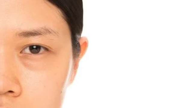 改善眼袋淚溝，為什么推薦眶隔脂肪釋放？周顯玉醫(yī)生告訴你