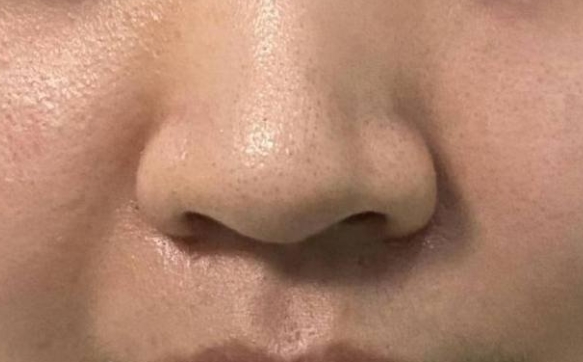 千萬不要外切你的鼻翼，讓你的鼻頭自然縮小