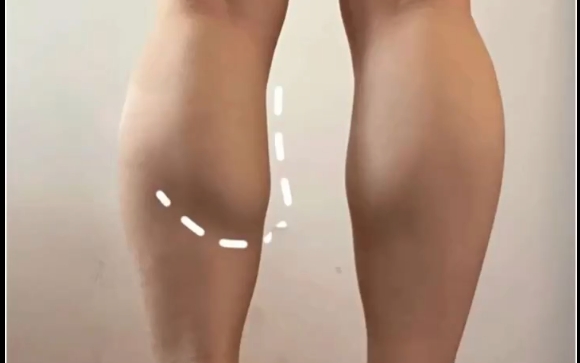 女生腿粗很難瘦？你真的了解自己的腿嗎？