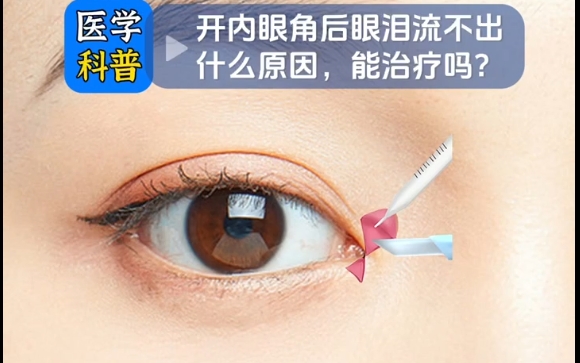 開內(nèi)眼角后，眼淚流不出的原因及修復(fù)方法