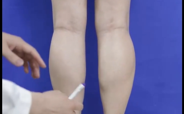 瘦腿針？吸脂？到底哪個(gè)方式可以改善小腿粗？