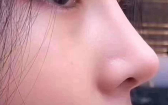 鼻背長痘一直沒有消，醫(yī)生：別扣了，線穿出來了！