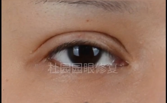 中重度上瞼下垂修復(fù)后，還會(huì)復(fù)發(fā)？杜園園醫(yī)生為你解答