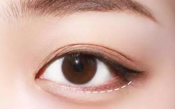 微創(chuàng)手術(shù)做出來的臥蠶是永久的嗎？