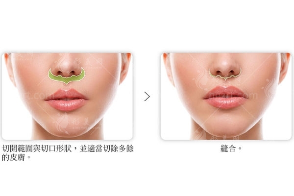人中縮短術(shù)六個月效果圖對比 人中縮短術(shù)六個月效果圖對比