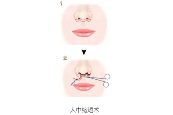 人中縮短術(shù)長期效果跟蹤對比 人中縮短術(shù)長期效果跟蹤對比