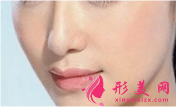 軟骨隆鼻的優(yōu)缺點(diǎn)有哪些？