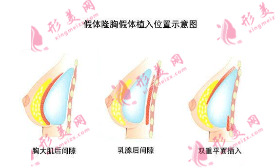 假體隆胸多少錢？做假體隆胸需要注意什么?