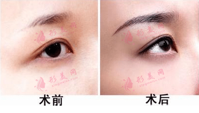 眉毛移植費用多少錢？眉毛移植效果怎么樣？